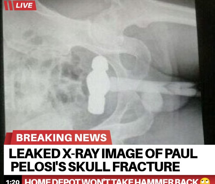 Click image for larger version. 

Name:	x-ray-image-of-paul-pelosis-skull-fracture.jpg 
Views:	1247 
Size:	74.1 KB 
ID:	21447