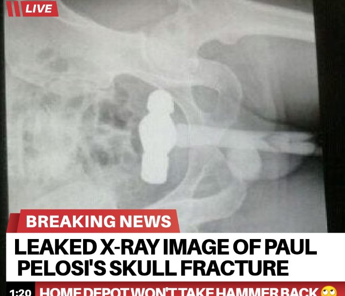 Click image for larger version. 

Name:	x-ray-image-of-paul-pelosis-skull-fracture.jpg 
Views:	1214 
Size:	74.1 KB 
ID:	21447